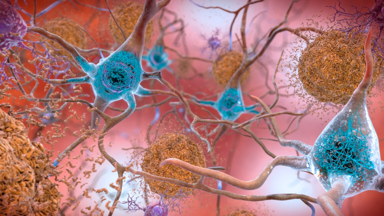 Bufeurile, un indicator timpuriu pentru Alzheimer? – studiu